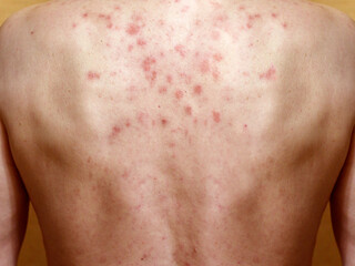 Naklejka premium Dermatitis on skin of a man`s back. Allergic reaction. Allergic rash on chest skin. Dermatitis. Seborrheic dermatitis
