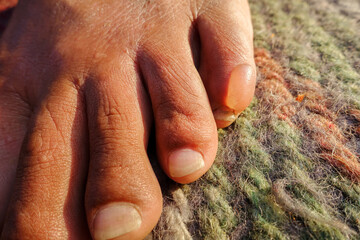 A close up shot of water filled blister on foot due to long walks. A blister is a pocket of fluid...