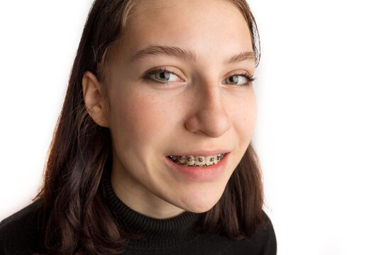 Orthodontic treatment. Dental care concept. Smiling teenage girl with braces. Metal braces close-up on the teeth.