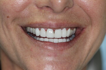 Fototapeta premium New smile with new teeth. smile makover