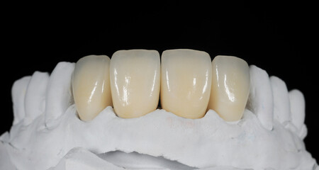Fototapeta na wymiar Dental zirconia crowns in the plaster model