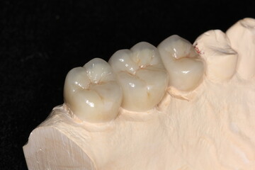 Dental zirconia crowns in the plaster model