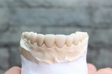 Fototapeta na wymiar Dental veneers in the plaster model. smile makeover