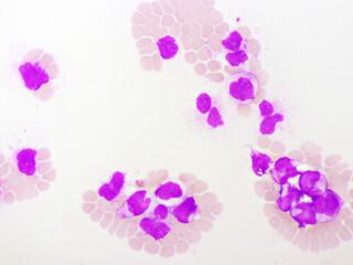 Acute promyelocytic leukemia cells or APL, analyze by microscope, original magnification 1000x