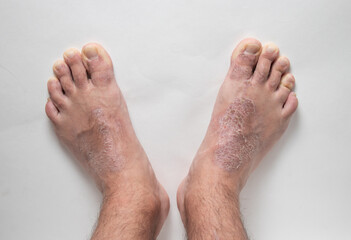 Close-up of leg. A person suffering from chronic psoriasis with the finger the inflamed part of the legs, on a white background. Allergy reaction.