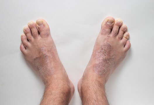 Close-up of leg. A person suffering from chronic psoriasis with the finger the inflamed part of the legs, on a white background. Allergy reaction.