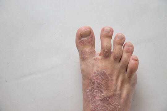 Close-up of leg. A person suffering from chronic psoriasis with the finger the inflamed part of the legs, on a white background. Allergy reaction.