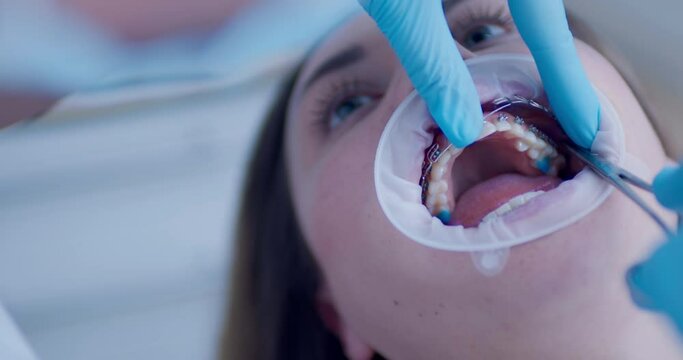 Close-up a female patient face with an optragate on her mouth and laying in the dental chair while a medical hand is establishing a multiloop edgewise archwire on an upper jaw by using dental forceps.