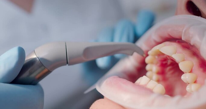 Close-up a male patient is laying in the dental chair with an optragate while a dentist using a dental air handpiece for drying teeth.