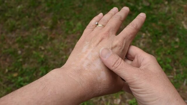 Vitiligo hands autoimmune disease