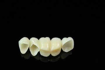 Zirconia bridge with all porcelain baked