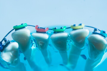 Metal teeth brackets