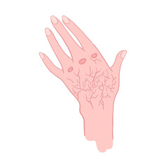 Woman hand with dry skin damaged by cracks - vector isolated illustration