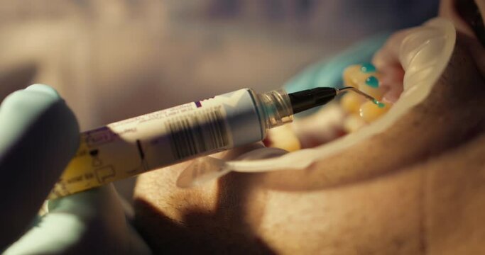 Close-up a male patient is laying in the dental chair with an optragate while a dentist's hand is applying to his upper jaw blue glue for fixing braces by using a dental syringe.