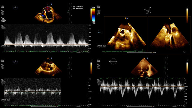transesophageal and transthoracic ultrasound images of the human heart