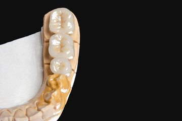 ceramic dental bridge for molars and premolars. on a black background. copy space