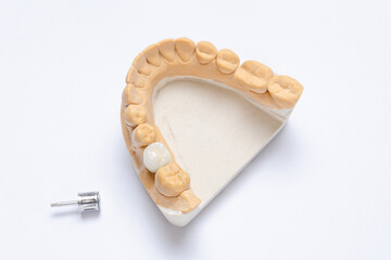 ceramic crown molar on a dental implant. lower jaw plaster model