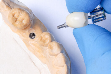 the dentist's hand holds a ceramic crown for fixation on the implant. dental model with dental implant