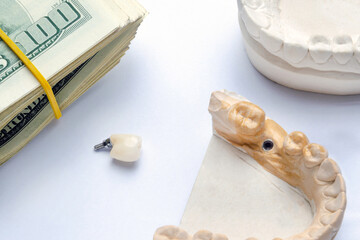 dental crown and implant on a white background. in the upper right corner there are dollar bills. the concept of planning and costly treatment at the dentist