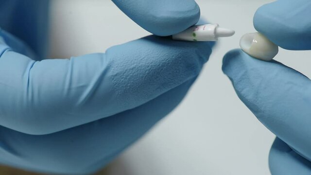 Dental veneers close up in doctor hands. Modern orthodontics. Close up