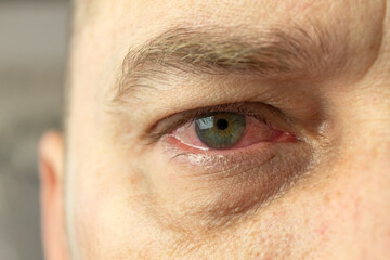 Close-up of a red and inflamed eye - obrazy, fototapety, plakaty