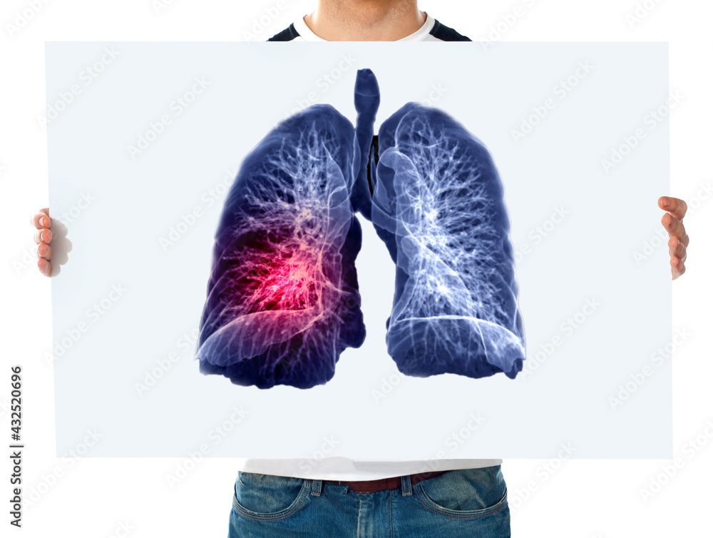 Poster man holding white poster with 3d rendering image of lung.
