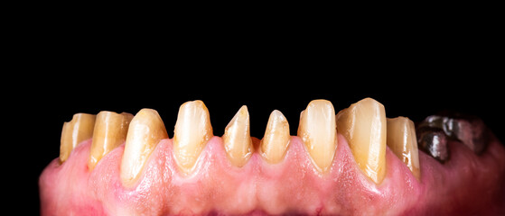 press ceramic crowns and veneers b2 color