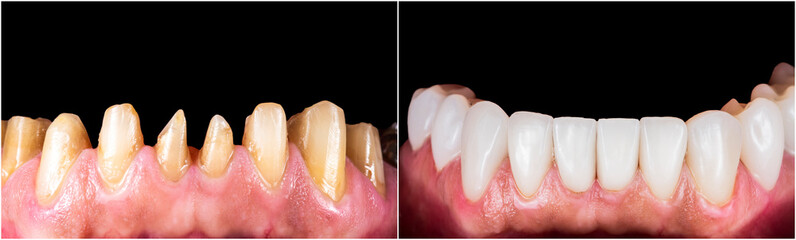 press ceramic crowns and veneers b2 color
