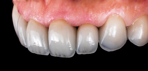press ceramic crowns and veneers b2 color