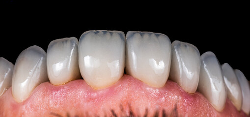 press ceramic crowns and veneers b2 color