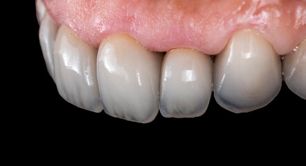 press ceramic crowns and veneers b2 color