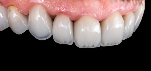 press ceramic crowns and veneers b2 color