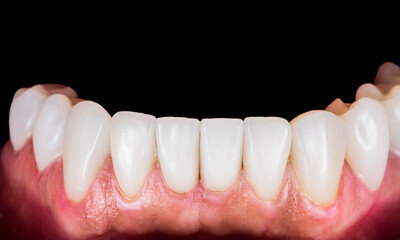 press ceramic crowns and veneers b2 color