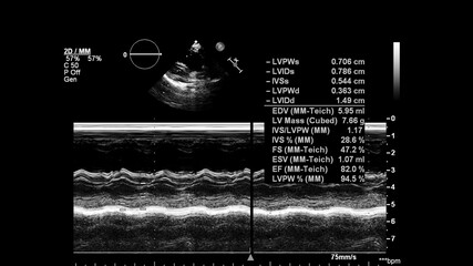 Image of the heart in gray-scale mode during transesophageal ultrasound.