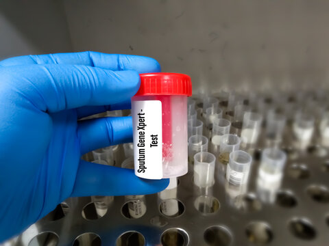 Sputum sample container holding by doctor for Genexpert test. A molecular test for detecting TB bacteria.