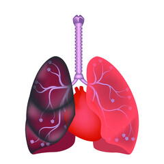 smoker's lungs. Defeat from nicotine. Harm of tar from a cigarette. Pneumonia with covid-19. Vector illustration.