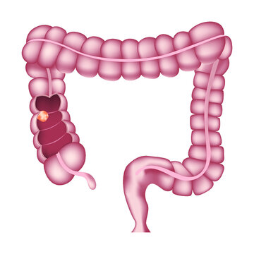 bowel cancer. Internal organs anatomy. Tumor. Vector illustration.