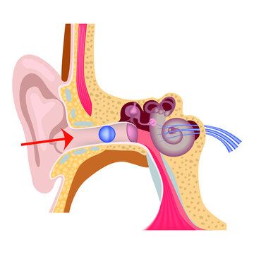 Foreign body in the inner ear. The structure of the human auditory system. Medical poster. Vector illustration