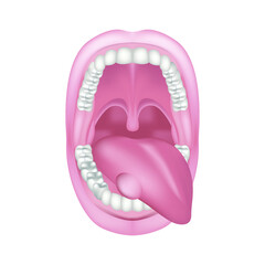 Swelling in the tongue. Wide open mouth. Upper and lower jaw with teeth. Disease of the oral cavity. Medical illustration.
