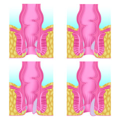 stages of development of hemorrhoids. Gradual proliferation of hemorrhoidal plexuses. Anatomy of the human anus. Vector illustration.