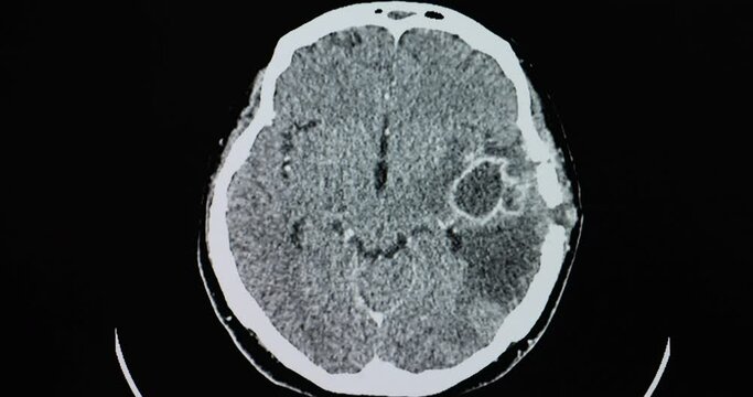 A CT brain scan of a patient with large abscess in the left temporal lobe.