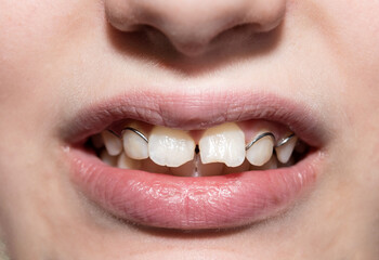 Naklejka premium Baby's teeth. Teeth. Teeth alignment plate. Dental Plate