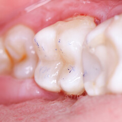 tooth cavity treatment with light cure composite