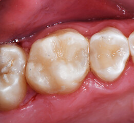 tooth cavity treatment with light cure composite