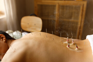Relaxed female patient lying on treatment table having rest while her nude back being covered with acupuncture sterile needles and burning moxa. Unrecognizable woman undergoing moxibustion therapy
