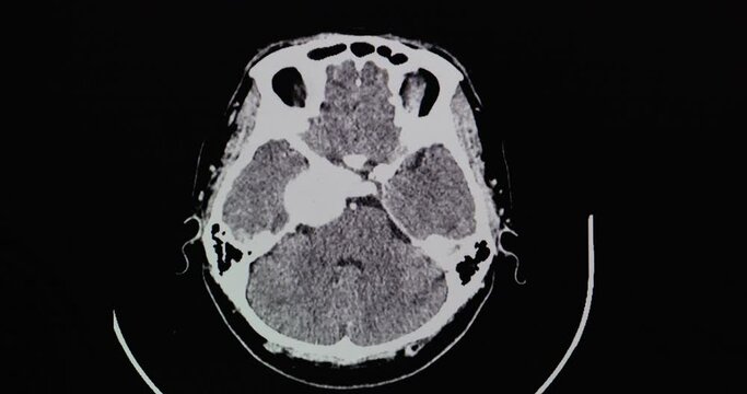 CT brain scan with contrast of a patient showing 3.8 cm rim enhancing lesion at right cavernous sinus with internal calcification most likely menigioma or extra axial tumor. Right temporal craniotomy.