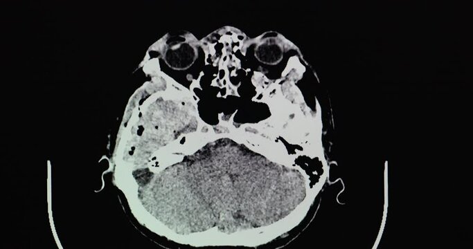 A CT brain scan of a patient with epidural hematoma at right temporal convexity with mass effect. Tension pneumocephalus. Multiple facial, sinuses, and base of skull fractures.