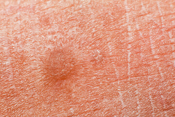human skin texture. Flat wart on skin micro photo. close up photo.
