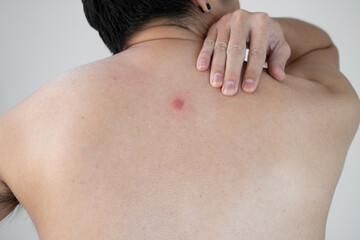 The back of a young Asian man with red abscesses or pimples.