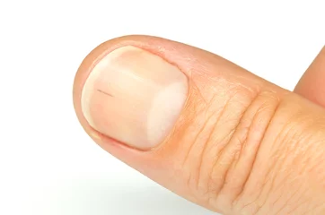 Thumb fingernail with sliver. Splinter under the nail close-up. Macro image
